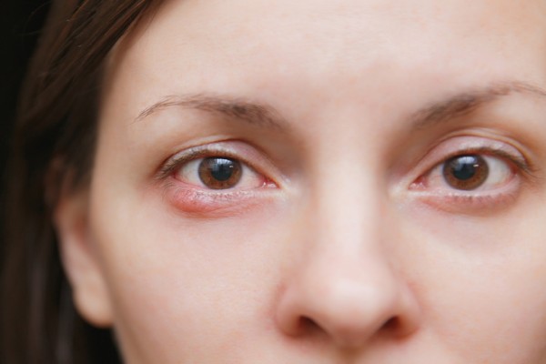 Ячмень на глазу: причины, симптомы и лечение