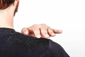 1296x728_is_dandruff_contagious_header