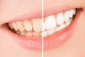 Whiten - smile and teeth whitening treatment before and after.