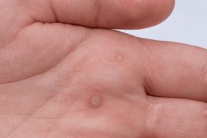 wart