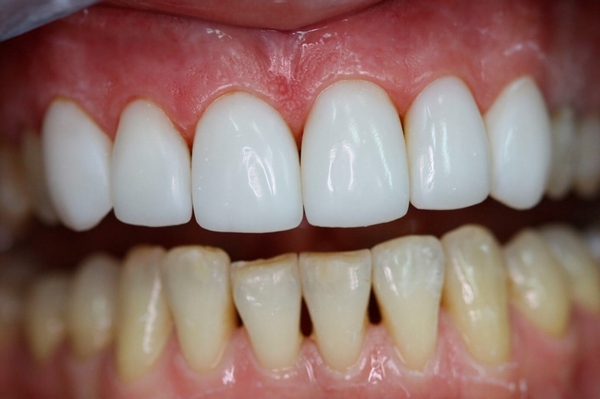Что такое виниры для зубов и зачем их устанавливать