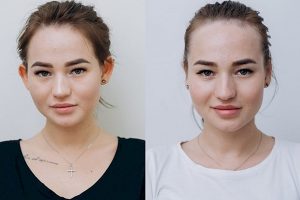 Отопластика: особенности, виды и показания
