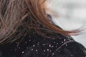 cropped-dandruff-falling-1200x600