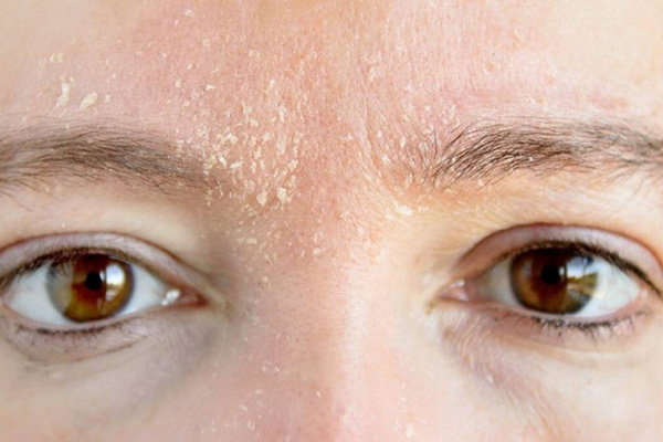 Что делать, когда шелушится кожа на лице?