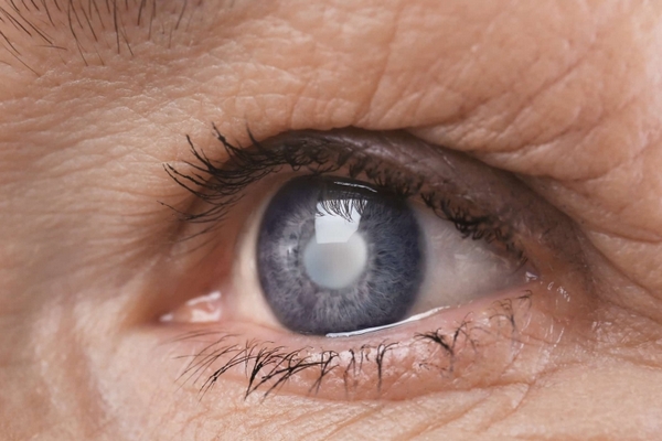 Глаукома: симптомы и виды заболевания