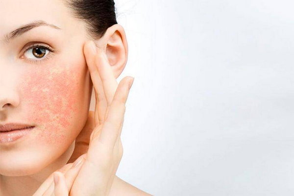 Купероз кожи – симптомы и уход