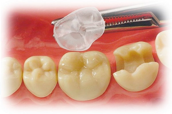 Керамічні вкладки: ефективний спосіб відновлення зубів
