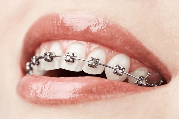 Почему бесконтрольное ношение брекетов и элайнеров может нанести вред вашим зубам