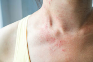 Young,Woman,Has,Skin,Rash,Itch,On,Neck