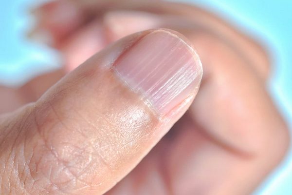 Ногти стали ребристыми: почему так произошло и что делать в таком случае