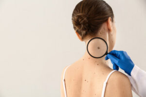 Dermatologist,Examining,Moles,Of,Patient,On,Light,Background