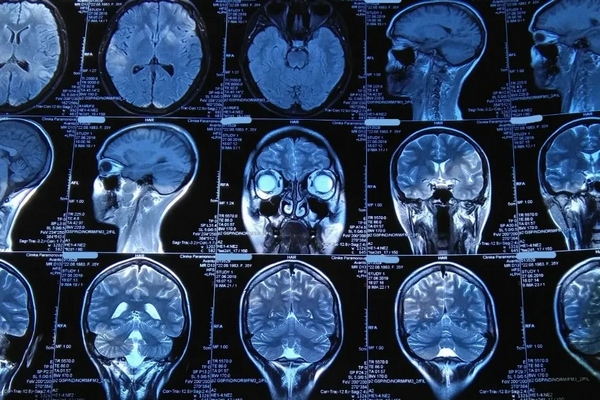 Когда делается МРТ головы и МРТ с контрастом