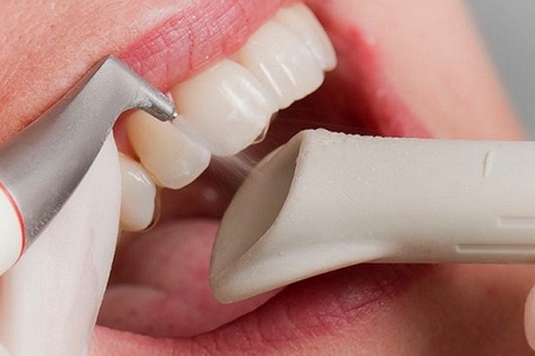 Почему крошатся зубы — неочевидные причины