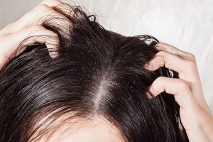 Dander that causes itching scalp