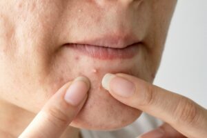 Acne pus, Close up photo of acne prone skin, Woman squeezing her
